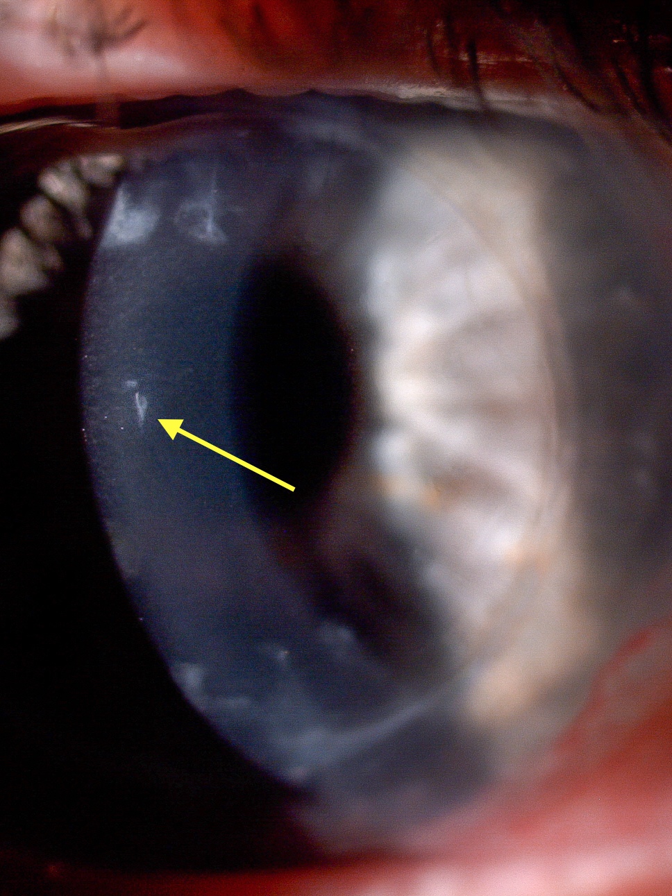 Blunt Trauma with Scleral Lens - Global Insight